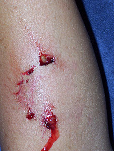 This is similar to the bite The Firecracker suffered.  (image via google search) 